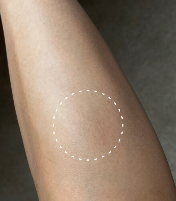 Image of a person's leg where you can see that a cut has healed
